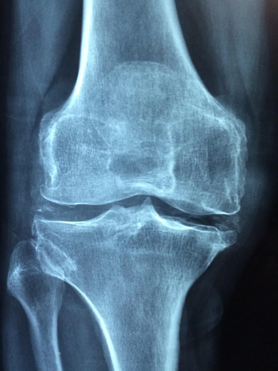 Radiographie de face d’un genou — support d’enseignement des techniques de reconstruction et de prothèse
